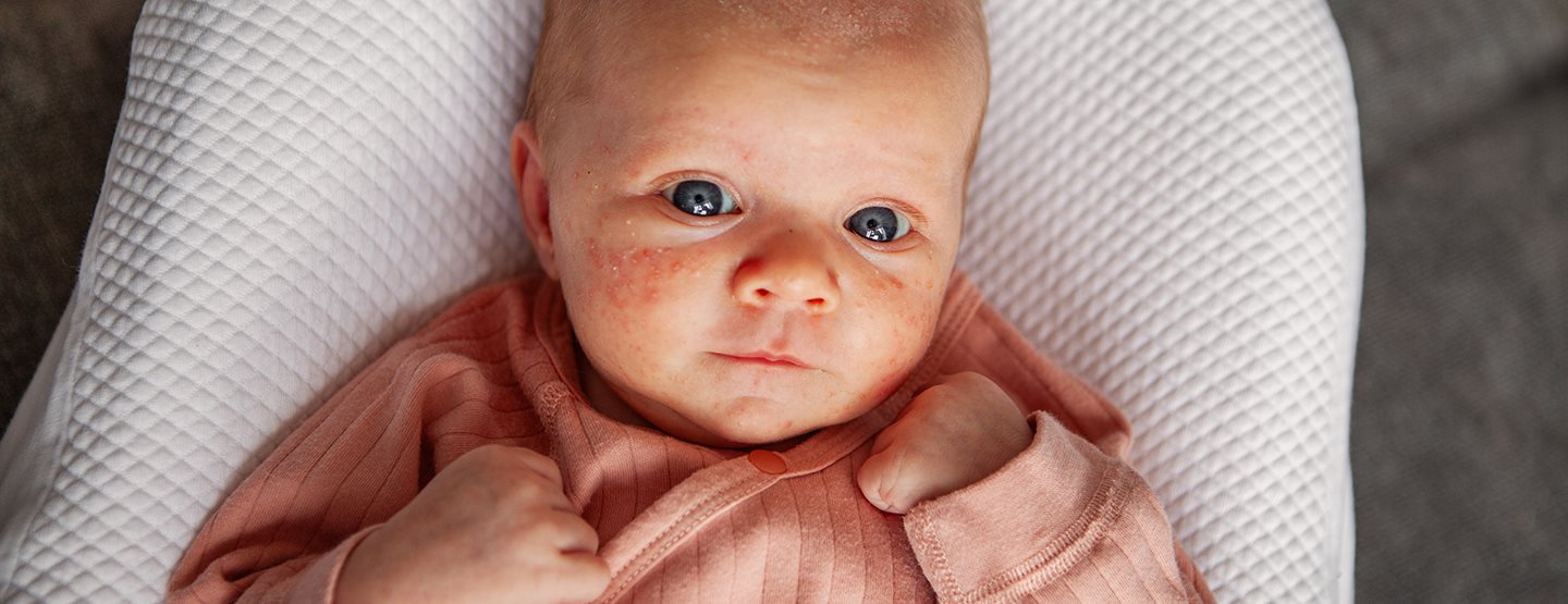Бебешко акне: Детски дерматолог споделя опит
