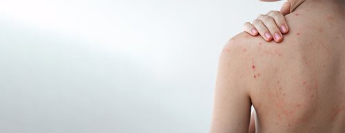 „Bacne“ или акне по гърба: Какво съветва дерматологът?